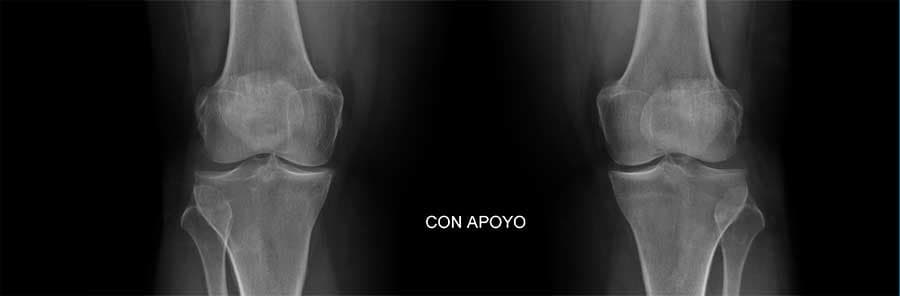 Infiltraciones mÃ©dicas y viscosuplementaciÃ³n para dolor articular de rodilla en MedellÃ­n