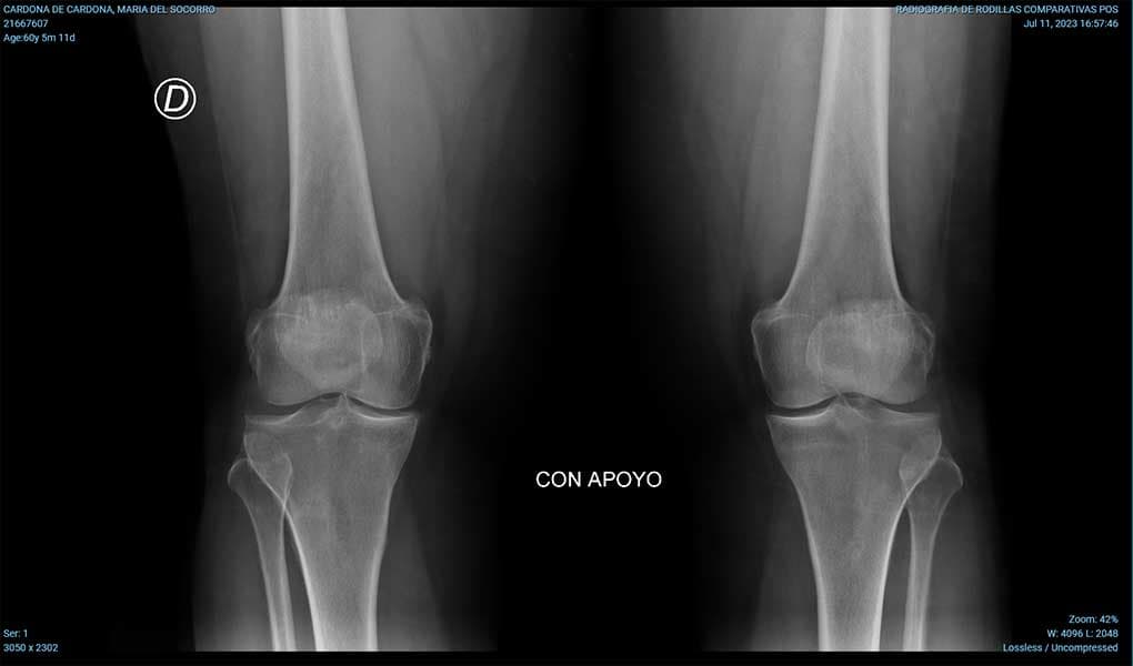 Viscosuplementación e infiltraciones para dolor de rodilla en Medellín